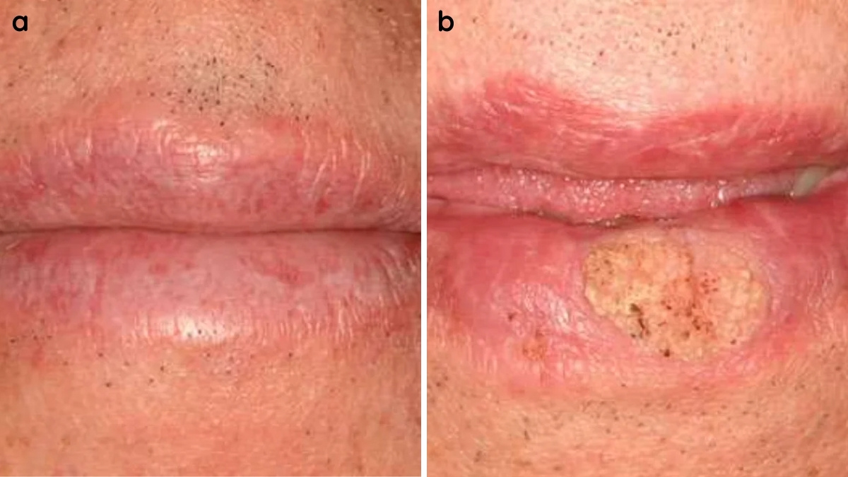 Hình 7. Nguy cơ biến đổi ác tính trong bệnh mảnh ghép chống chủ mãn tính.