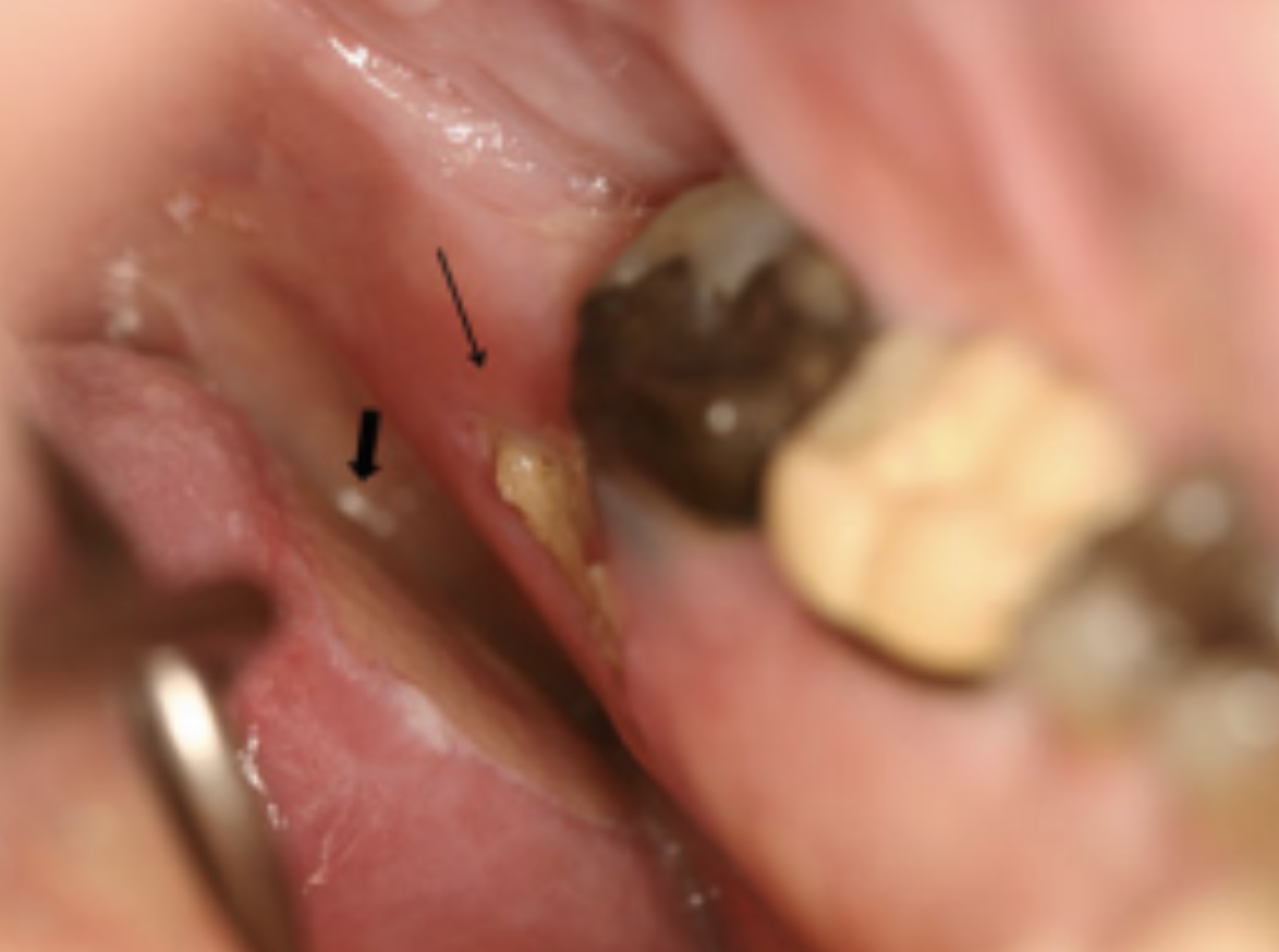 Hình 2. Vết loét thứ phát ở bên trái lưỡi (mũi tên ngắn) do ma sát với các cạnh sắc của xương hoại tử lộ ra trên đường hàm móng hàm dưới bên trái (mũi tên dài). Bệnh nhân cảm thấy đau lan xuống cổ họng. Xương được mài nhẵn bằng một cái dũa và vết loét đã được tiêm Triamcinolone Acetonide, giúp giảm đau ngay lập tức và lành vết thương nhanh chóng.