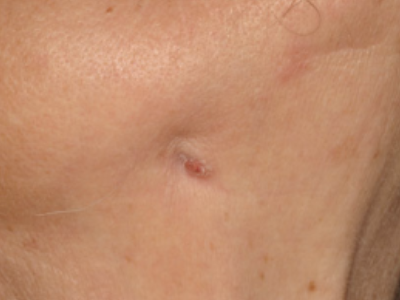 Hình 3. Lỗ dò ngoài miệng ở hàm dưới bên phải trên bệnh nhân MRONJ tiến triển 