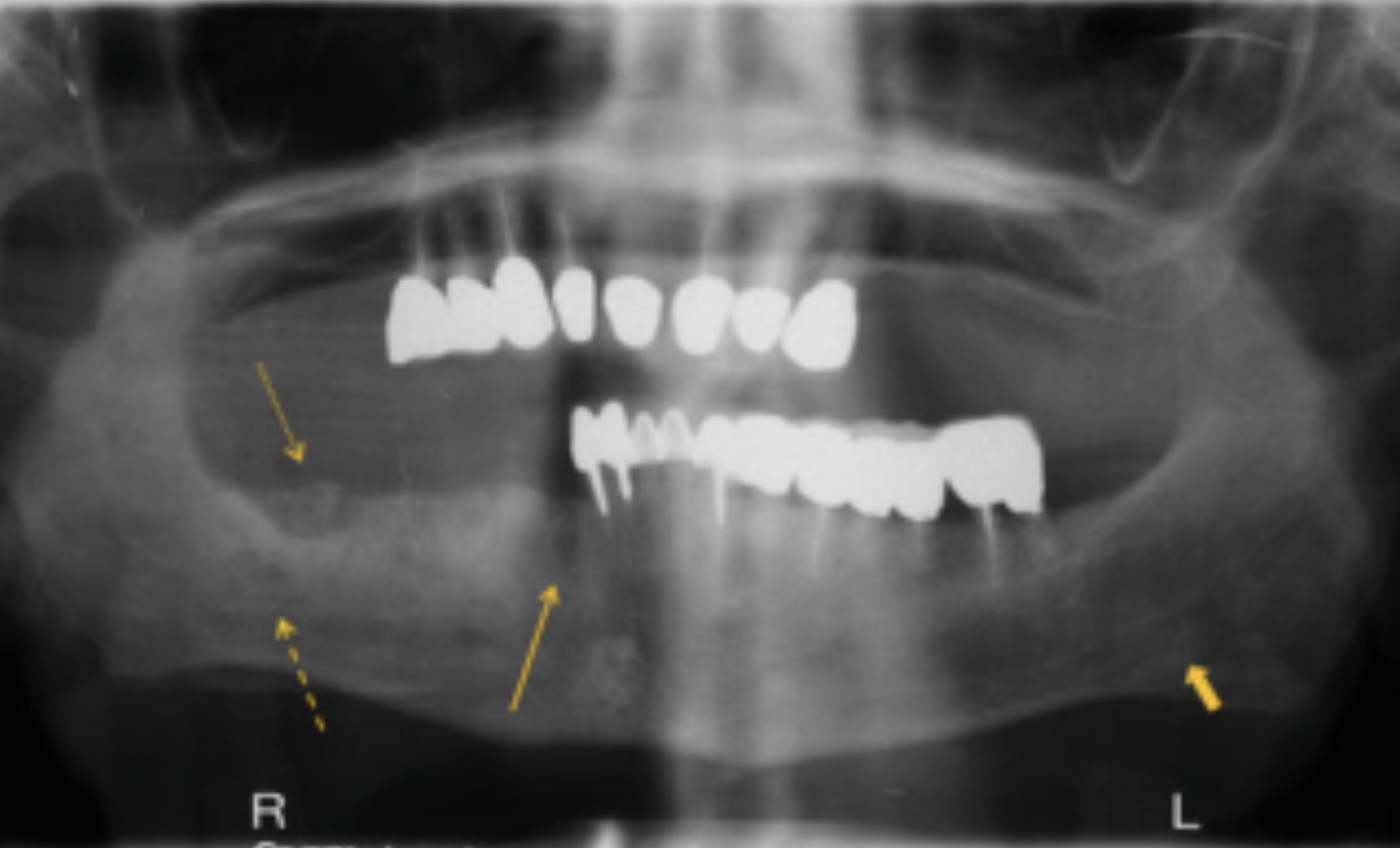 Hình 4. Các đặc điểm X quang đặc trưng của MRONJ. Ở phía bên phải có một ổ răng cũ tại vùng răng tiền cối - nơi một chiếc răng đã được nhổ 2 năm trước (mũi tên đặc, dài), bề mặt không đều với phần xương mục (mũi tên chấm) và xơ cứng diện rộng làm mất ranh giới của động mạch huyệt răng dưới (mũi tên nét đứt). Lưu ý, so sánh với phía bên trái, trông tương đối bình thường. Động mạch huyệt răng dưới bên trái được nhìn thấy rõ ràng (mũi tên đặc ngắn).