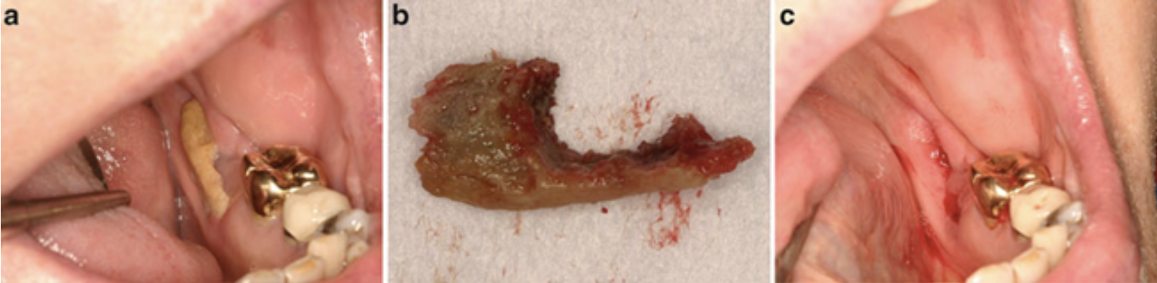 Hình 5. Hoại tử xương hàm liên quan đến thuốc với diện tích hoại tử lớn, lộ ra xương trên đường hàm móng hàm dưới bên trái cùng với hình ảnh tổ chức mô mềm bao xung quanh khỏe mạnh. (a) Sờ nắn xương cho thấy sự di động, quan sát có một khối xương hoại tử lớn. (b) Khối xương được loại bỏ không đau với hình ảnh mọt gặm mà không cần gây tê tại chỗ. (c) Sự lành thương ngay lập tức sau khi loại bỏ khối xương hoại tử
