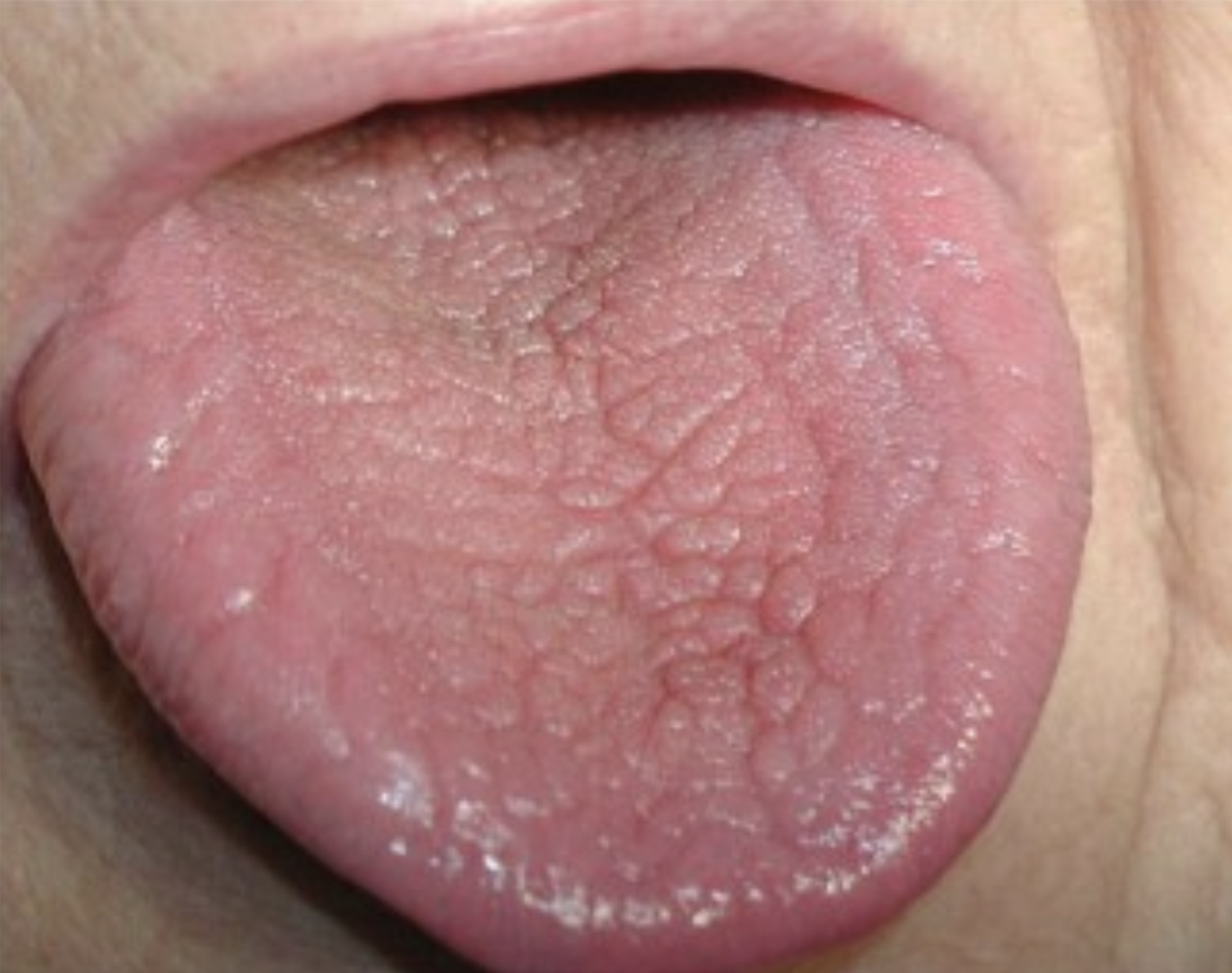 Hình 3. Khô miệng