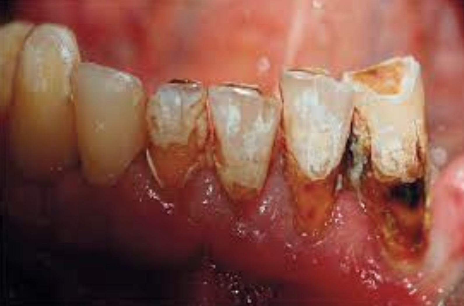 Hình 4. Sâu răng do xạ trị